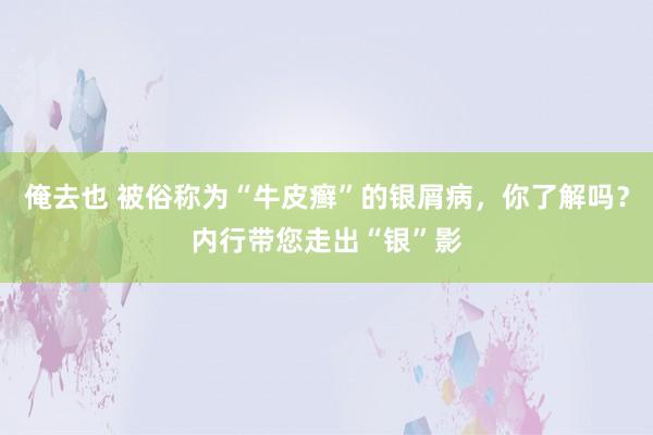 俺去也 被俗称为“牛皮癣”的银屑病，你了解吗？内行带您走出“银”影